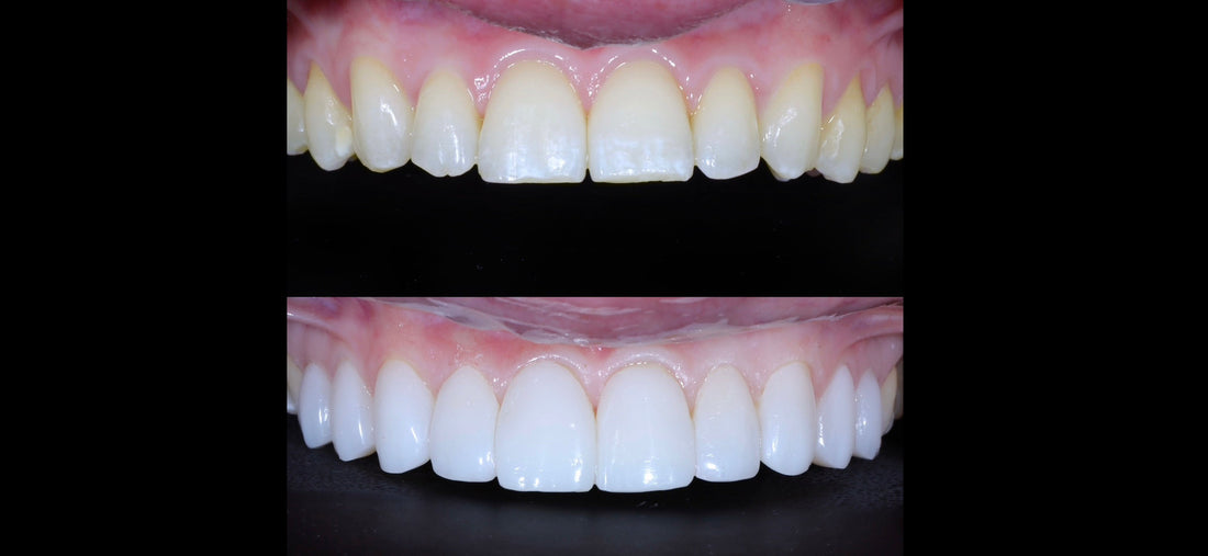 The Art of Composite Bonding