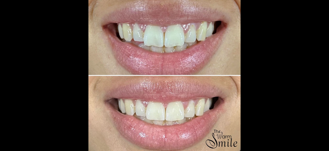What is Teeth Reshaping?