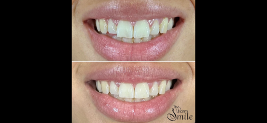 What is Teeth Reshaping?