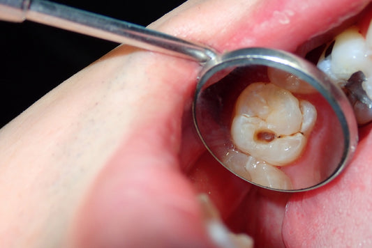 What are the Signs and Symptoms of Tooth Decay?