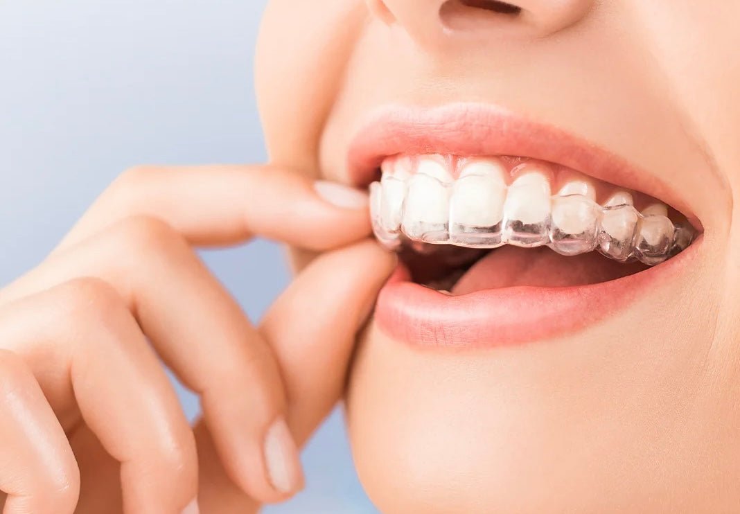 How Does Invisalign Work? A Step-by-Step Guide