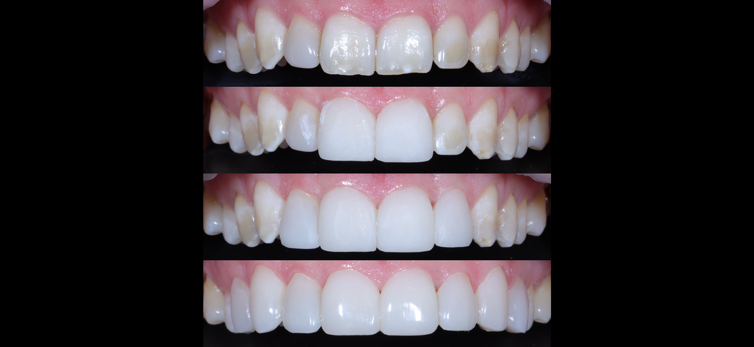 Does Composite Bonding Damage Your Teeth?