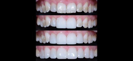 Does Composite Bonding Damage Your Teeth?