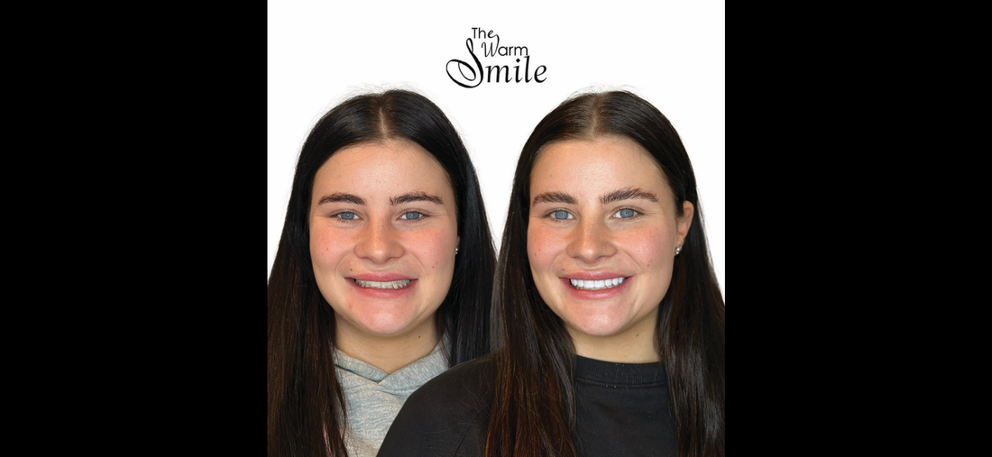 Composite Bonding Melbourne – Natural Smile Enhancement Without Veneers