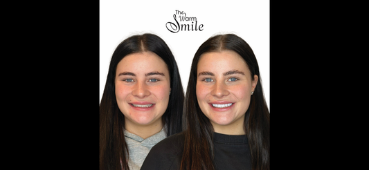 Composite Bonding Melbourne – Natural Smile Enhancement Without Veneers