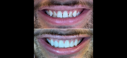 Can Composite Bonding Fix Gaps in My Teeth Without Braces?