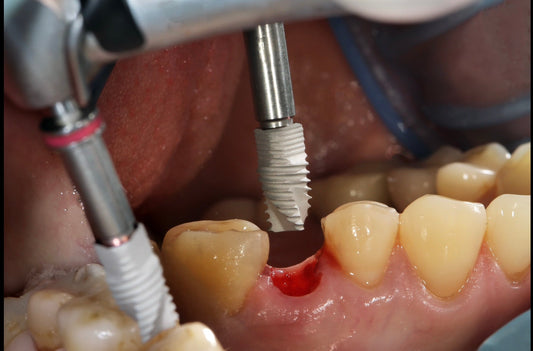 How Much Do Dental Implants Cost in Melbourne?