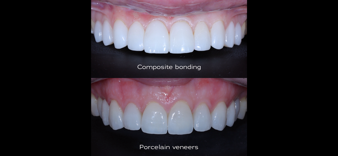 Composite Bonding vs. Porcelain Veneers: Which Is Better for You?
