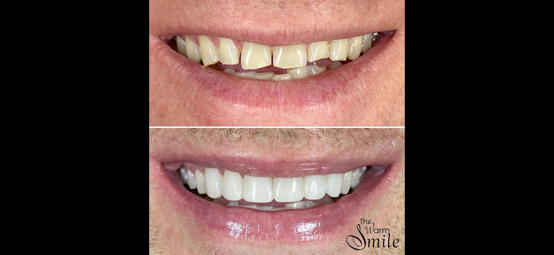 Can Composite Bonding Fix Worn, Short, Flattened or Uneven Teeth?