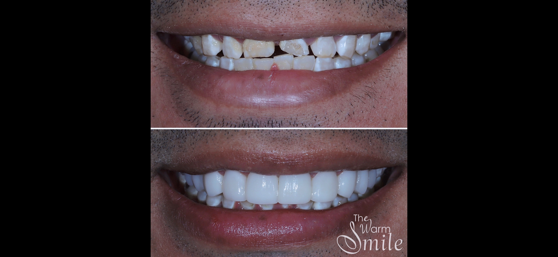Composite Bonding for Worn Teeth: How It Can Restore Tooth Shape and Smile Function