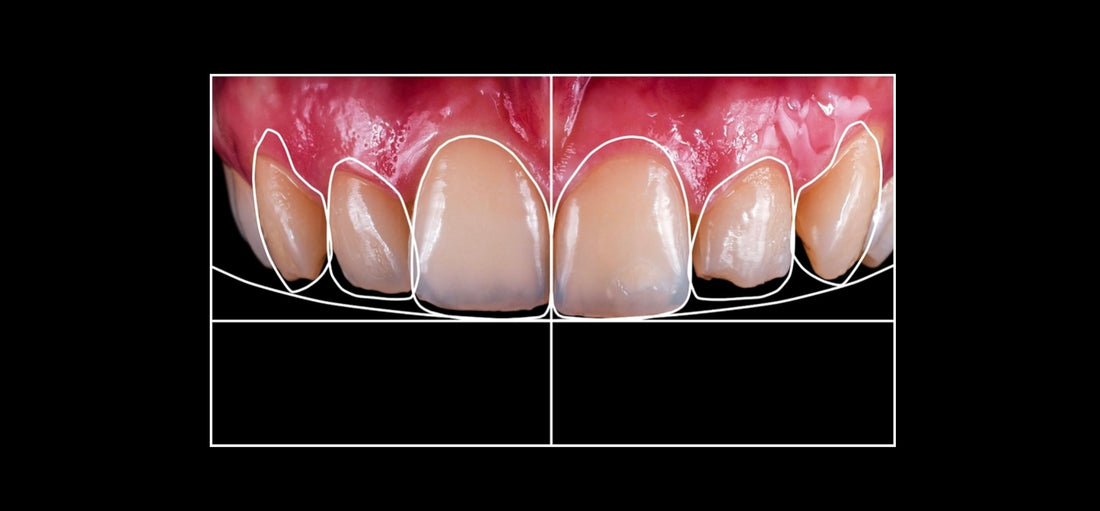 How Much Do Veneers Cost in Melbourne?