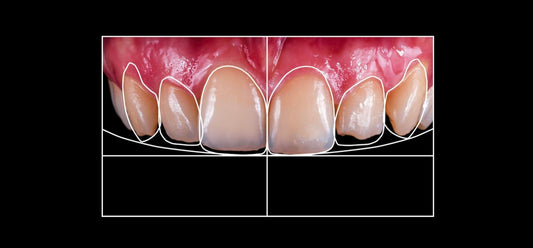 How Much Do Veneers Cost in Melbourne?