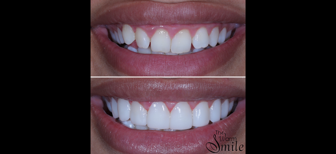 How the Composite Bonding Process Works: A Simple, Painless Smile Transformation