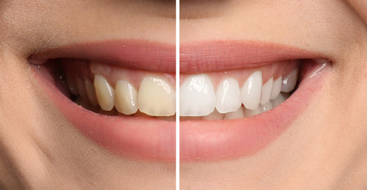 Brighten Your Smile: The Benefits of Dental Whitening