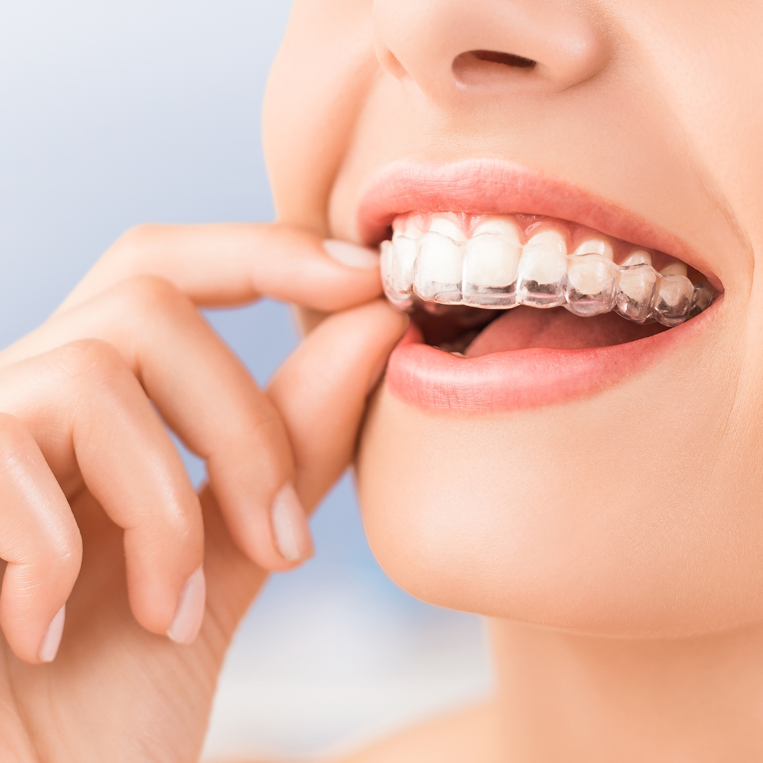Best quickest and cheapest Invisalign Melbourne