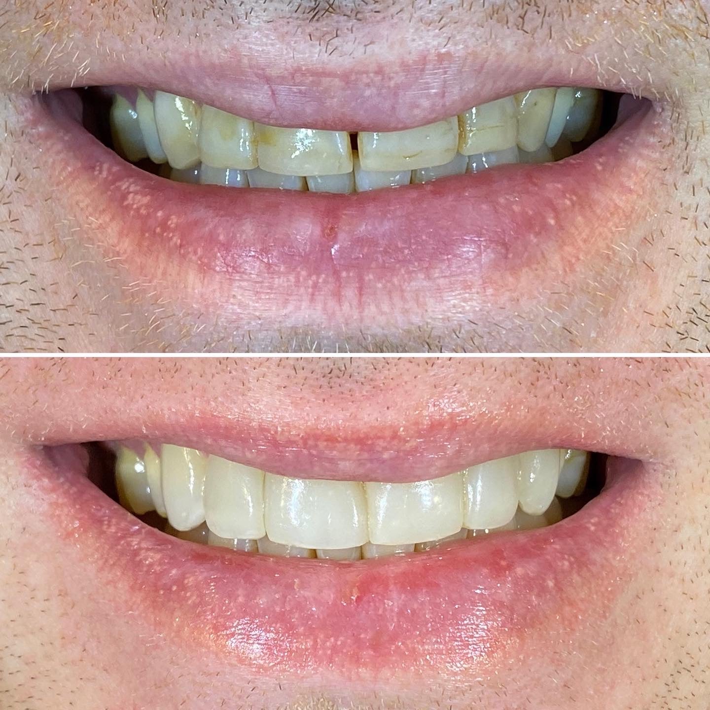 Composite bonding in Melbourne. Composite veneers. Dental bonding.