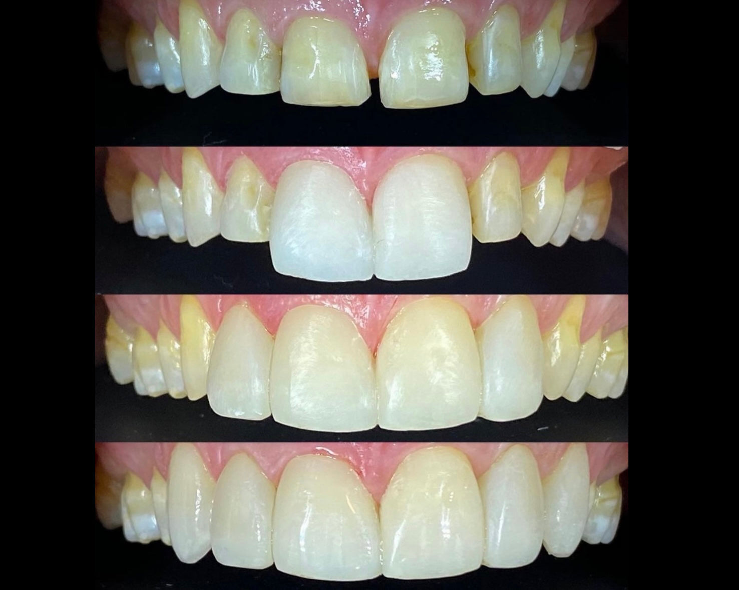 Composite bonding in Melbourne. Composite veneers. Dental bonding.