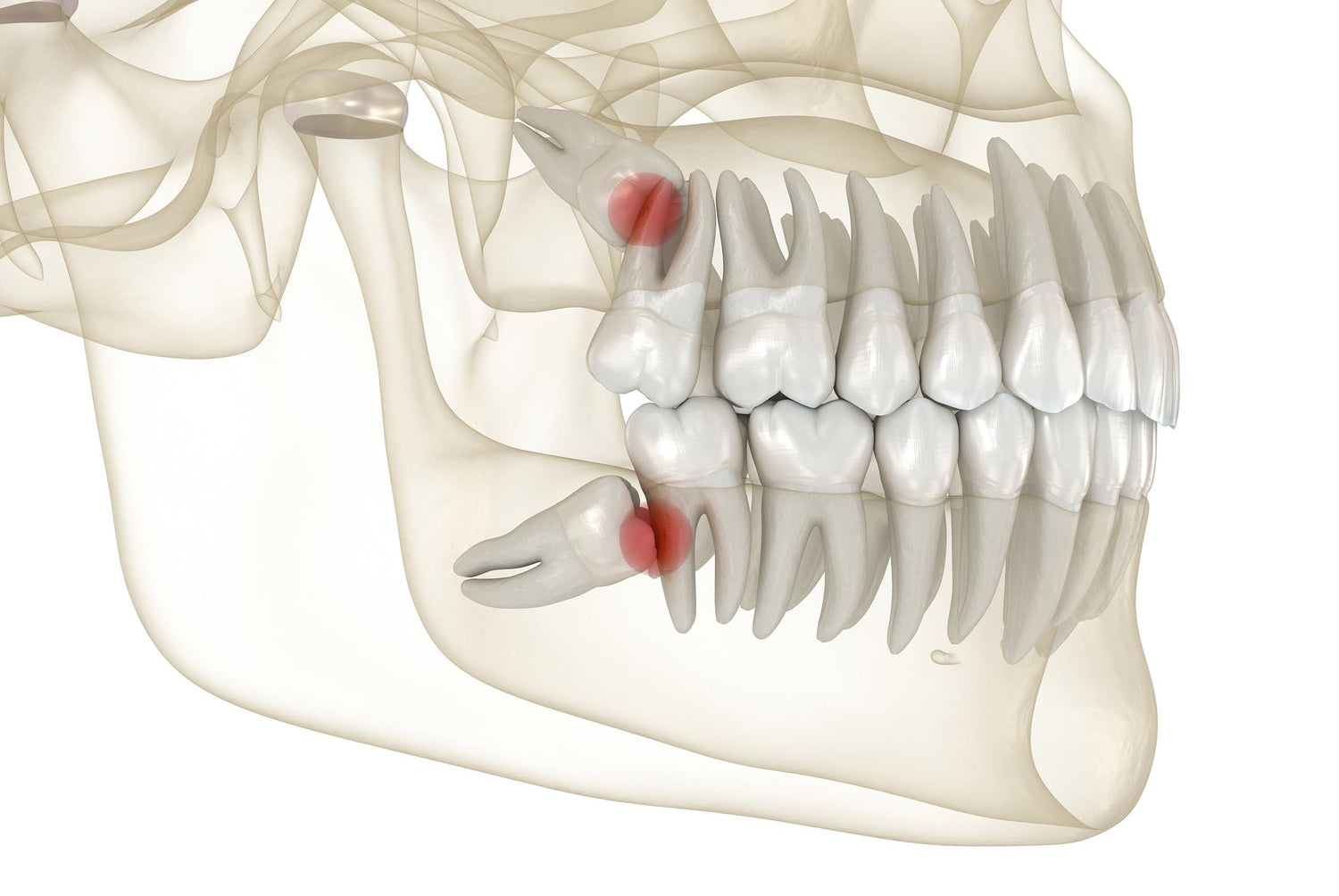 wisdom teeth removal in Melbourne. Wisdom tooth removal. Wisdom teeth surgery. The Warm Smile. Dental clinic in Melbourne.